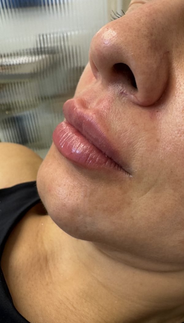 Preenchimento labial — contorno definido